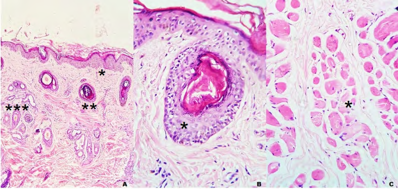 Figure 1: A. Skin (ear). Mild dermal edema (*), perivascular dermatitis (**) and interface folliculitis poor in cells, follicular atrophy (***) and moderate dermal fibrosis (hematoxylin/eosin staining, 40x). B. Skin (cephalic region). Perivascular and hyperplastic dermatitis, partially hyalinized vascular wall (*) (hematoxylin/eosin staining, 400x). C. Temporal muscle. Moderate fibrosis and varying degrees of muscle fiber atrophy (*) (hematoxylin/eosin staining, 400x). Font: Errante, et al. [28].