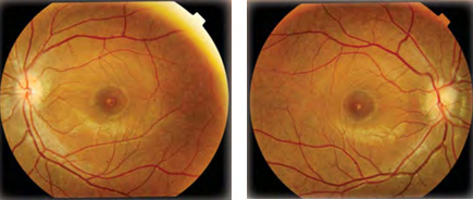 Figure 1: Fundus photograph showed discrete yellow lesions at the fovea of both eyes.