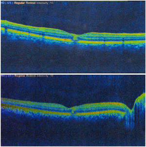 Figure 2: OCT showed retinal pigment epithelial defects in both eyes and disruption of the inner and outer segments of the photoreceptor layers.