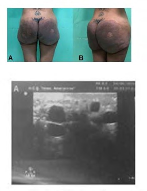 Figure 1: ** Preoperative period. A: Rear view. B: Side view.