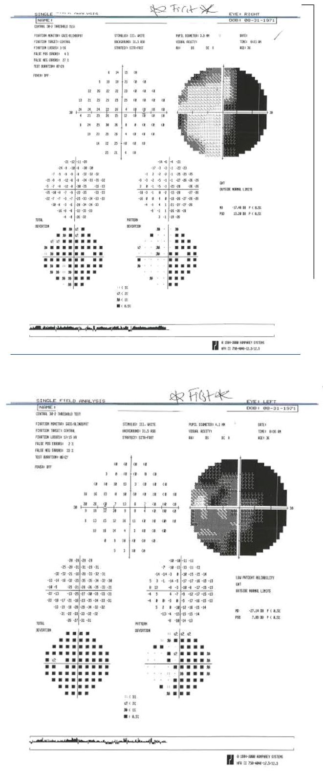 Figure 1: Humphrey Visual Field 30-2 showed depression consistent with right homonymous hemianopsia on right eye and diffused depression on the left eye consistent with optic atrophy.