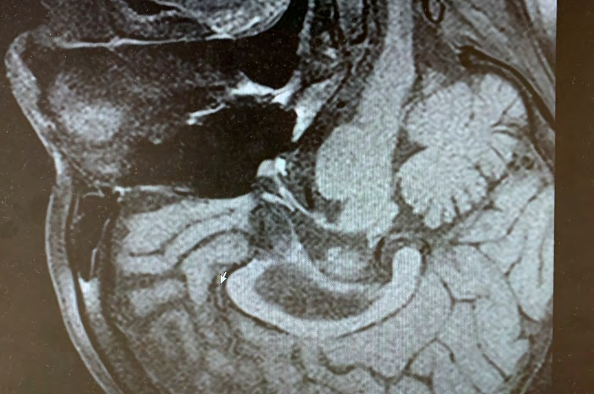 Figure 2: ** Computed tomography of chest. Arrow indicates lung metastasis. (a) Before nivolumab, (b) after 10 cycles, (c) after 15 cycles, (d) after 23 cycles (>20% enlargement). (e) Head MRI during adrenal hypofunction. No tumorous lesion was found in the pituitary gland. The posterior lobe showed an area of signal intensity on T1W1 imaging. (f) Sparse hair and 3-cm diameter alopecia in the occiput.
