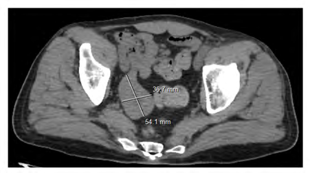 Figure 1: CT = pelvic mass at the expense of an ileal loop.