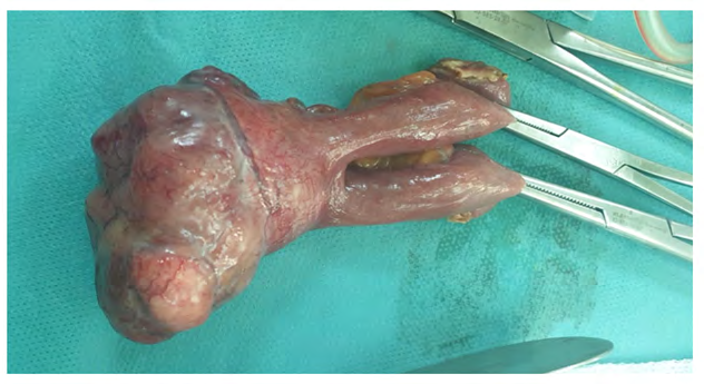 Figure 2: Resection specimen showing exophytic ileal tumor mass.