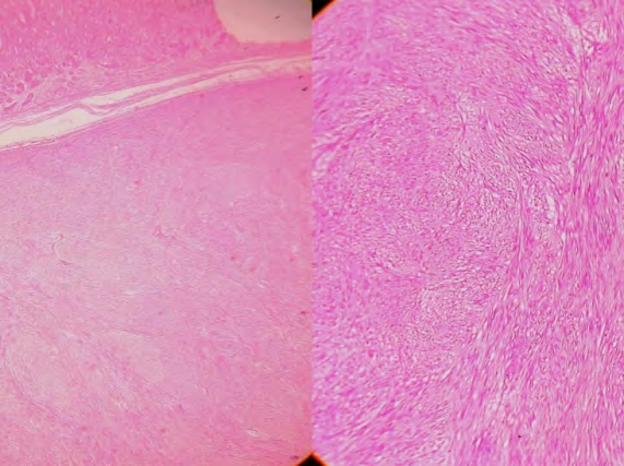 Figure 4: H&E (4x) - Section shows wall of the stomach with a lesion in the muscularis propria. H&E (10x) Section shows uniform spindle shaped cells with cigar shaped nuclei arranged in interlacing bundles and fascicles.