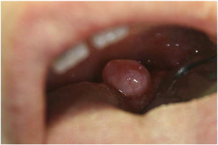 Figure 1: Osseous choristoma depicting a pedunculated, non-erythematous growth with a smooth, non-ulcerated surface and a narrow base [8].