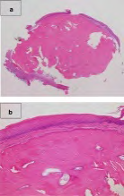 Figure 8: Osseous choristoma exhibiting a nodular, sessile, bony mass composed of mature bone and superimposed stratified squamous epithelium [14].