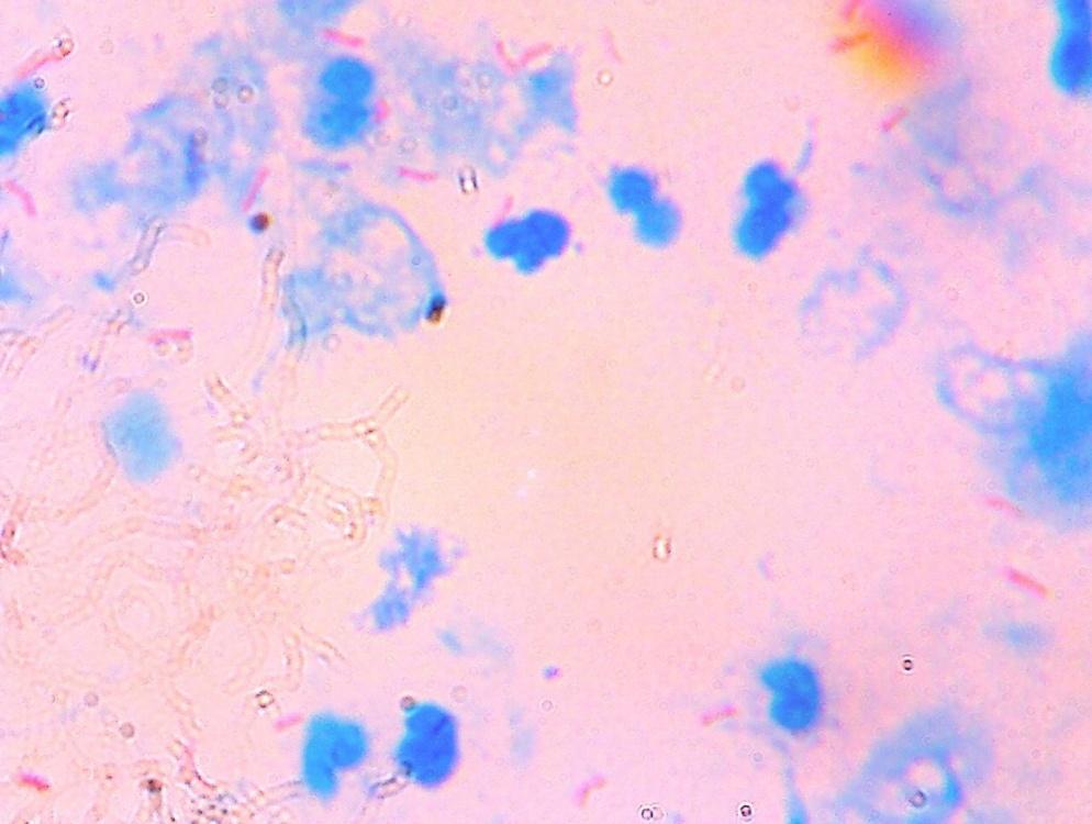 Figure 2: Smear from FNA of the cervical lymph node positive for AFB.