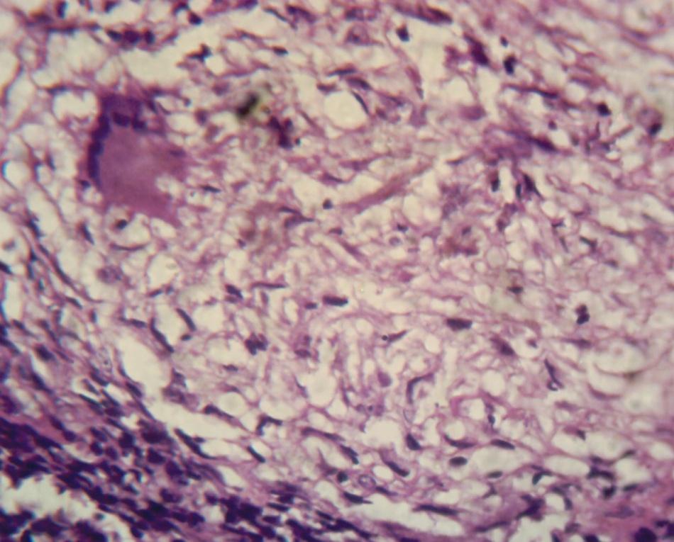 Figure 3: Smear from FNA of the cervical lymph node positive for AFB.