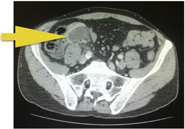 Figure 1: CT shows appendix mass surrounded by fat- stranding, periappendiceal abscess and appendicolith. Some reactive lymph nodes are identified. The appendix showed a length of 4.5 cm and 1 cm in diameter. Frozen biopsy revealed a goblet cell carcinoid with goblet cells arranged in cohesive clusters, no desmoplasia and minimal cytological atypia. Perineural and perivascular infiltration were also found (Figure 2). Immunohistochemistry was performed and demonstrated immunoreactivity for cytokeratin 20, cytokeratin 7 and CEA; andfocal positivityfor endocrine markers (chromogranin A or synaptophysin) (Figure 3). In addition, goblet cells displayed preserved immunoreactivity for MUC1 and MUC2, which is not the common pattern for typical goblet cell carcinoid. Also, P53 was positive in 5-10% of tumoral cells (Figure 4). In conclusion, the patient was diagnosed of GCC group A, T3N0Mx. After surgery, colonoscopy and thoracoabdominal CT were performed. Neither of them revealed distant metastases. Tumoral markers (CEA, CA- 125 and CA-19.9) were within normal ranges. Eventually, the patient underwent right hemicolectomy. Histological study demonstrated neither tumoral cells nor affected lymph nodes. Adjuvant FOLFOX regimen was considered. Currently, the patient is under chemotherapy and doing well.