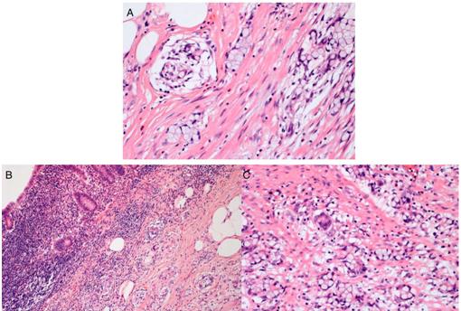 Figure 2: The wall of the appendix shows minimal distortion (A). Well-defined goblet cells cluster in a cohesive architecture (B), and infiltrate muscular layer in a linear pattern (C).