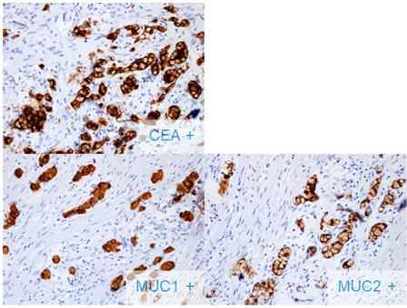 Figure 4: Goblet cells show positivity reactivity for CEA, and both MUC1 and MUC2 are preserved (although, most tumors of group A display negative immunoreactivity for MUC1 and MUC2 preserved).