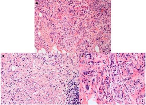 Figure 5: Atypical goblet and signet ring cells are arranged in irregular clusters with no cohesion (A). No confluent sheets of signet ring cells are identified. Desmoplastic and cytological atypia are present. (B). Moreover, some foci of typical GCC are found (C).