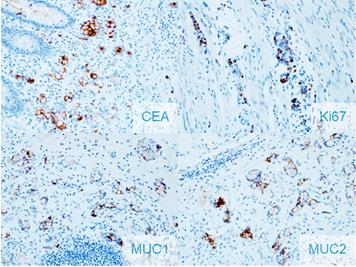 Figure 7: The goblet cells preserve MUC1 and MUC2 immunostaining, with proliferation index, Ki-67, of 30%, and positive immunoreactivity for CEA.