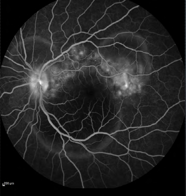 Figure 4: OCT OD showed a subretinal highly reflective lesion (red arrow) adjacent to the serous retinal detachment and a bacillary layer detachment near the optic disk.