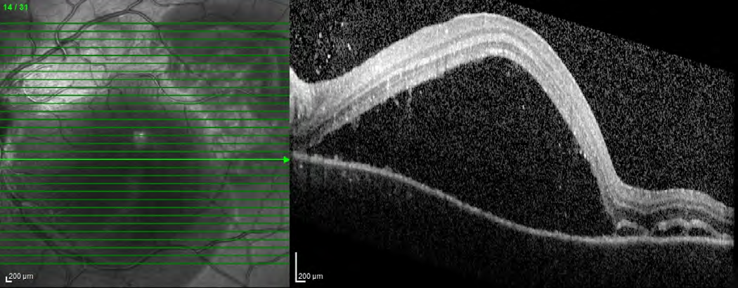 Figure 6: OCT OD showed complete improvement the serous retinal detachment and resolution of the subretinal highly reflective lesion.