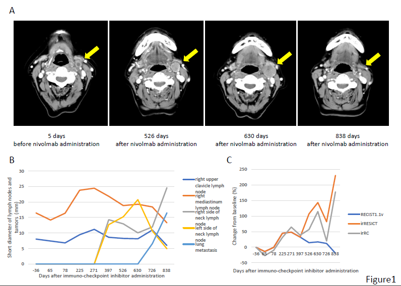 Figure 1: Metastasis to the lymph node on the left side of the neck during nivolumab treatment in Case 1 (A). Changes in metastatic tumor size in the lymph nodes and lung in Case 1 (B). The metastasis emerged after 18 courses increased from 13.2 mm to 23.1 mm (long diameter, +75%) after 30 courses, then decreased to 7.22 mm (-45%) after 39 courses (A, B). Changes from the baseline as assessed by RECIST, ir-RECIST, and ir-RC in Case 1(C).