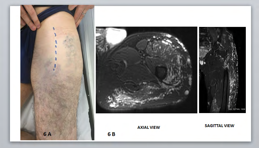 Figure 6: Clinical aspect and MRI in T2 fat sat. 6A: Anterior approach on the healthy skin cover 6B: Preoperative MRI in T2: Hyper signal specific of VM, axial view; moderate tissue involvement in the superficial and deep tissue (fascia lata, gluteal muscles), sagittal view: subcutaneous VM.