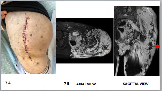 Figure 7: Significant tissue involvement around the hip. 7A: postoperative view of the lateral approach, no hematoma, no late healing 7B; Preoperative T2 MRI: axial view: extensive involvement of deep tissue around the joint (arrow). Hemostasis by sclerotherapysagittal view: significant VM in the subcutaneous tissue over the fascia lata muscle (arrow). Hemostasis by running sutures.