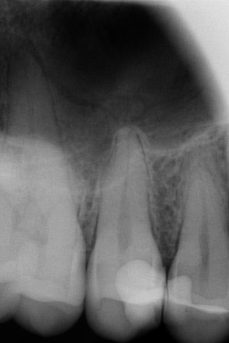 Figure 2: Panoramic Radiograph at initial consultation.