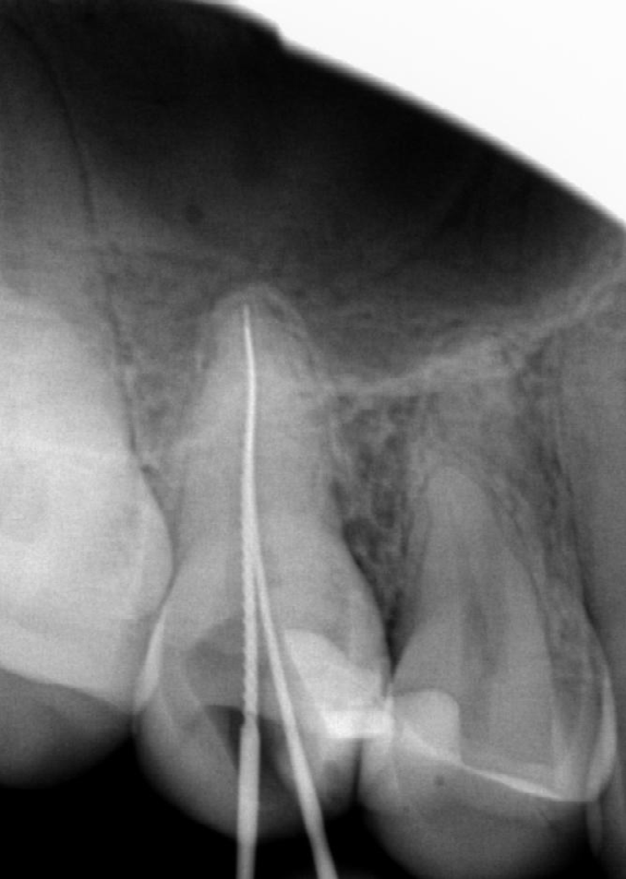 Figure 4: Preoperative x-ray, length determination.