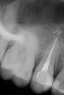Figure 7: The post-operative panoramic radiograph.