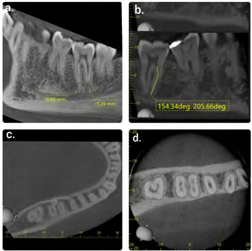 Figure 1: a. Distance of root apex of mandibular second molar from mandibular canal in Sagittal section. b. Degree of curvature present in mesial canal of mandibular second molar in Sagittal section. c. Presence of extra root (radix) in mandibular second molar in Axial section. d. Presence of C-shaped canal in mandibular second molar.