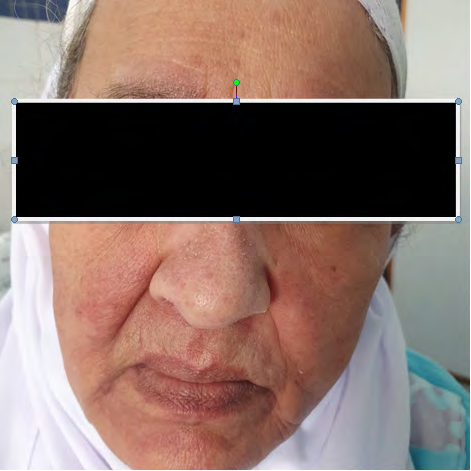 Figure 1: A lilac-colored rash on the face, reticulated, heliotrope-appearing rash on the upper eyelids.