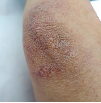 Figure 2: Erythematous, hyperkeratosis, scaly patches on the knee.