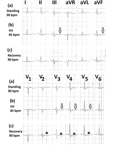 Figure 10: Electrocardiograms (a) in standing position showing a heart rate of 90 minutes; (b) during hyperventilation showing a heart rate of 85 minutes and T inversion of less than 1mm in leads III,aVF, V3 to V5 (marked⇓); (c) during 5th minute of recovery, showing downsloping ST-segment depression in leads V2 to V6 (marked∗).