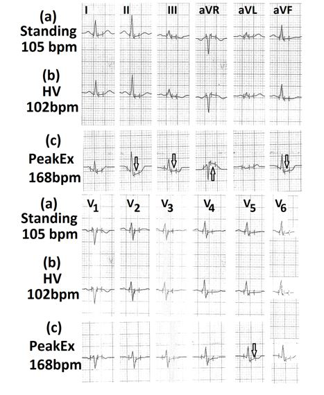 Figure 11: Electrocardiograms (a) in standing position showing a heart rate of 105/minute; (b) during hyperventilation and; (c) during peak exercise, showing significant ST-segment depression in leads II, III,aVF and V5 (marked⇓) with ST-segment elevation in lead aVR (marked⇑).