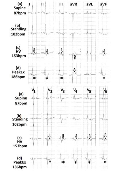 Figure 12: Electrocardiograms (a) in standing position; (b) during hyperventilation, showing the increase in height of R wave and inversion of T wave (marked ⇓) in lead V4; (c) during peak exercise, showing significant ST- segment depression in leads V4 to V6 (marked ∗) and T wave inversion in leads II, III,aVF (marked ).