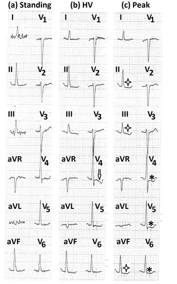 Figure 13: Electrocardiograms (a) in the supine position, showing minimal ST-segment depression in leads II, III,aVF, V4 to V6; (b) in standing position showing the increase in heart rate by 15 beats/minute and mild ST- segment depression and shallow T wave inversion in leads II, III,aVF, V3 to V6; (c) during hyperventilation, showing a further increase in heart rate by 51 beats/minute with the increase in ST-segment depression in leads I, II, III, aVF V2 to V6 (marked ⇓), and ST-segment elevation in lead aVR (marked⇑ ); (d) during peak exercise, showing a further increase in ST-segment depression in leads I, II, III, aVF, V2 to V6 (marked∗ ) and elevation in lead aVR (marked $$