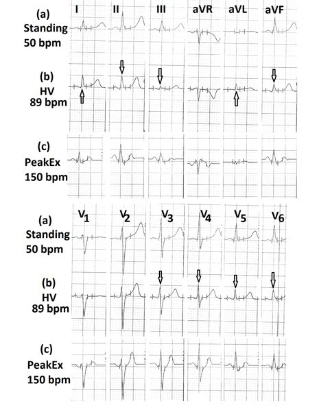 Figure 15: Electrocardiograms (a) during standing position; (b) during hyperventilation, showing the decrease in amplitude of R wave in leads II, III, aVF, V5 to V6 (marked ⇓) with the increase in the amplitude of R wave in leads I, aVL (marked⇑); (c) during peak exercise, showing absence of any ST-segment depression.