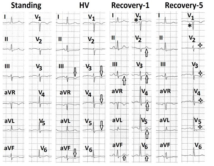 Figure 17: Electrocardiograms (a) during standing position, (b) during hyperventilation showing shallow T wave inversion in leads III, aVF, V2 to V5 (marked⇓); (c) during the first minute of recovery showing positive T waves in leads III, aVF, V2 to V5 (marked⇑) and negative terminal deflection of P wave in lead V1 (marked∗); (d) during 5th minute of recovery showing inverted P wave in lead V1 (marked∗) and downsloping ST-segment depression in leads V2 to V5 (marked **U Wave**: U wave was visible in two cases in the supine position. There was no change during hyperventilation. The number of patients showing various electrocardiographic $$
