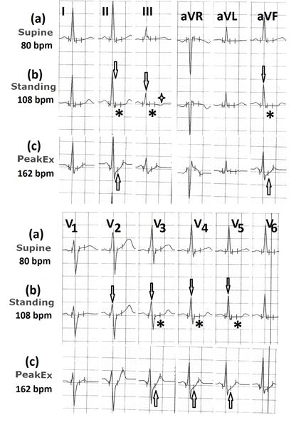 Figure 2: Electrocardiograms (a) In the supine position; (b) In standing position showing the decrease in amplitude of R wave (marked⇓ ) with horizontal ST segment (marked∗ ) in leads II, III, aVF and V2 to V5 and T wave inversion in lead III (marked ⇑); (c) during peak exercise showing upsloping ST-segment in leads II, aVF, V3 to V5 (marked ).
