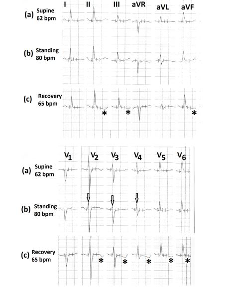 Figure 3: Electrocardiograms (a) in the supine position; (b) in standing position showing the decrease in R wave amplitude in leads V2 to V4 (marked⇓); (c) during 7th minute of recovery showing downsloping ST-segment in leads II, III, aVF and V2 to V6 (marked∗).