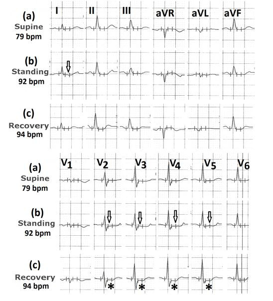 Figure 4: Electrocardiograms (a) in the supine position; (b) in standing position showing less than 1mm ST-segment depression in leads I and V2 to V5 (marked⇓); (c) during 3rd minute of recovery showing ST-segment depression in leads V2 to V4 (marked∗).