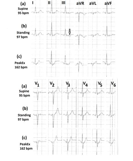 Figure 5: Electrocardiograms (a) in supine position showing mild inversion of T wave in lead III; (b) in standing position showing the increase in the magnitude of T wave inversion in lead III (marked⇓); (c) during peak exercise showing absence of any ST-segment depression.