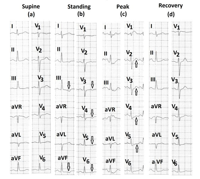 Figure 6: Electrocardiograms (a) in the supine position; (b) in standing position showing less than 1mm T wave inversion in leads III, aVF and V2 to V6 (marked⇓); (c) during stage 3 of Bruce protocol showing normalization of T waves in leads V2 to V5 (marked⇑); (d) during the third minute of recovery showing absence of any ST-segment depression.
