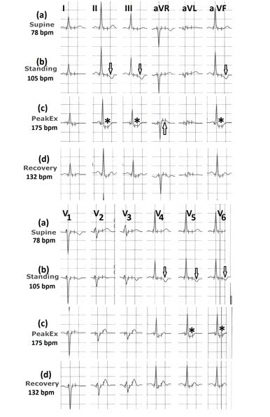 Figure 7: Electrocardiograms (a) in the supine position; (b) in standing position showing T wave inversion up to 2mm in leads II, III and V3 to V6, marked ⇓; (c) during peak exercise showing significant ST-segment depression in leads II, III, aVF, V5, V6 (marked ∗) with ST-segment elevation in lead aVR (marked⇑); (d) showing normalization of ST-segment changes within one minute of recovery.