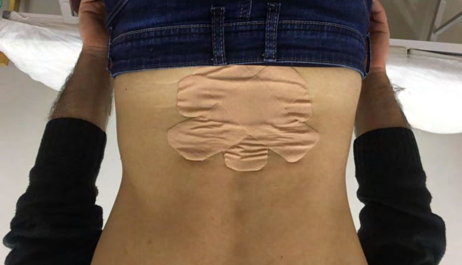 Figure 1: Kinesiology Taping Application.