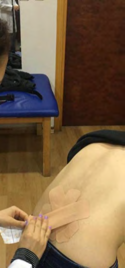 Figure 2: Kinesiology Taping Application.