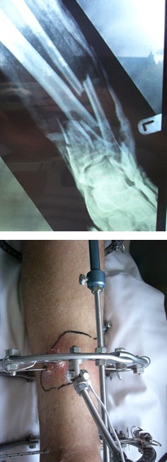 Figure 1: X-Rays of initial acute tibial plafond fracture. A: AP XR of tibial plafond fracture, B: Lateral XR of tibial plafond fracture A