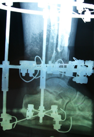 Figure 3: Surgical debridement of pin site infection and sequential photography of wound healing A: post-operative surgical debridement of pin site infection osteomyelitis. B: post-operative use of vacuum dressing. C: wound at 1-month post-surgical debridement. C: wound at 3- months post-surgical debridement.