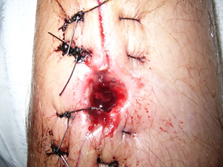 Figure 4: XR healed tibial plafond fracture 3 months following original injury A: AP XR of healed tibial plafond fracture, B: Lateral XR of healed tibial plafond fracture.