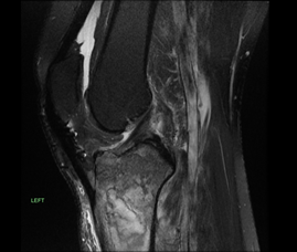 Figure 7: MRI of knee 17 years later. A: Coronal MRI of knee and proximal tibia. B: Sagittal MRI of knee and proximal tibia A B