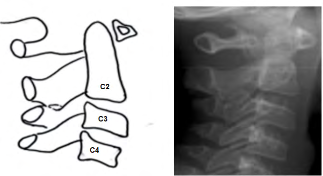 Figure 1: Normal cervical vertebrae.