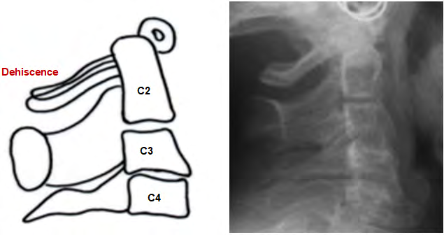 Figure 2: Dehiscence of Posterior arch of atlas vertebrae (C1).