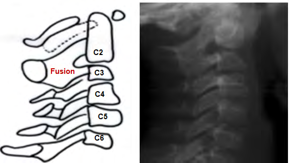 Figure 3: Fusion of C2-C3.